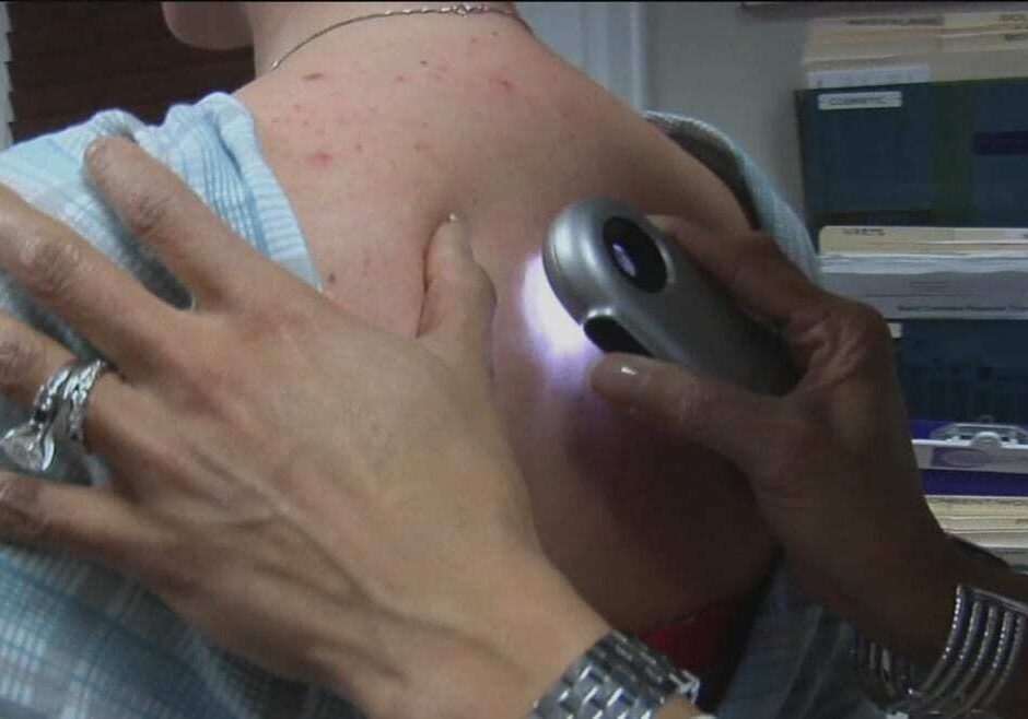 SkinCancer2