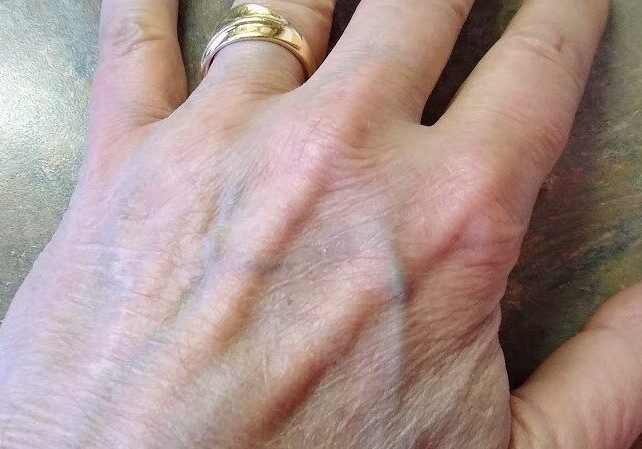 Bill Tammeus' left hand